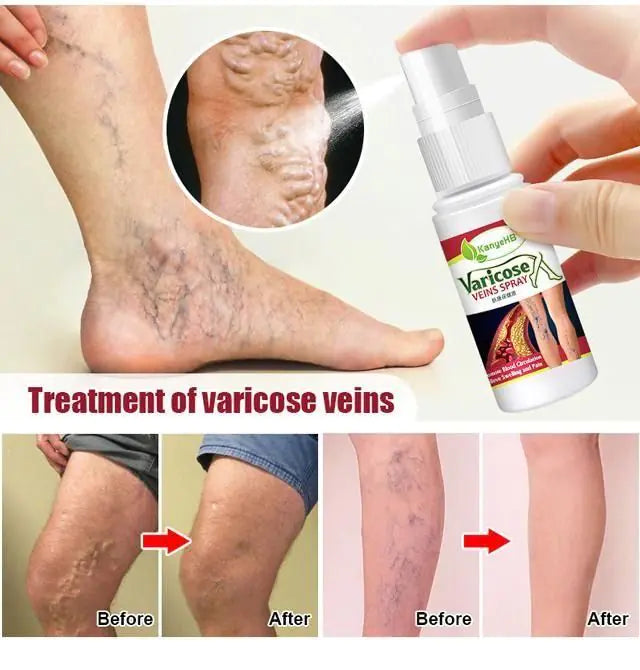 Varicose Veins Treatment Spray