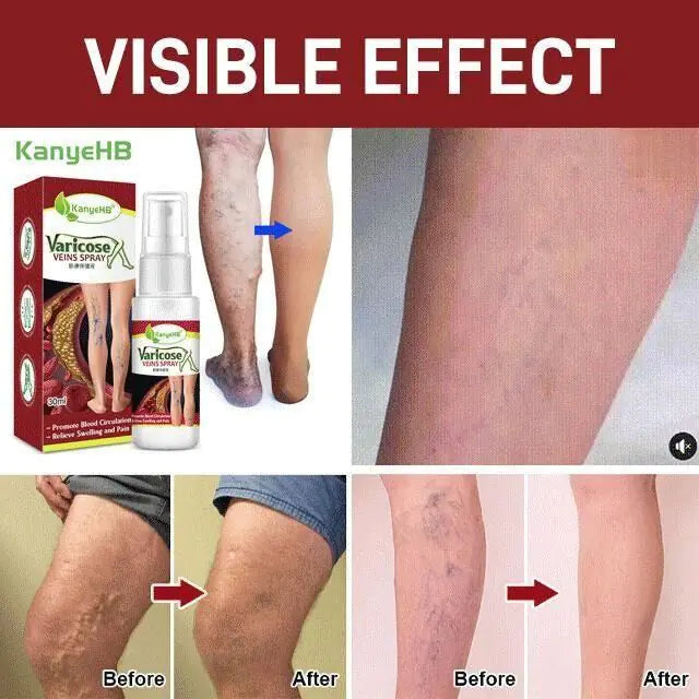 Varicose Veins Treatment Spray